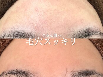 ルアナアイナ 大分/ハーブピーリング(6)