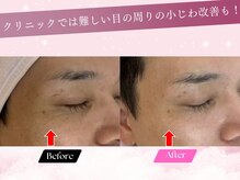 ルーム701(room701)/シミ　シワ　高級フェイシャル