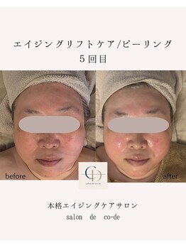 サロンドコーデ(salon de co-de)/エイジングリフトケア