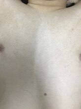 ナノハナ/鹿沼市の全身脱毛のナノハナ