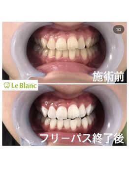 ルブラン 奈良店(Le Blanc)/ずっと白い歯に♪