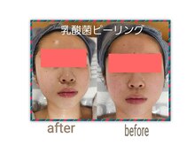 セレブリティ(Celebrity)/乳酸菌ピーリング 