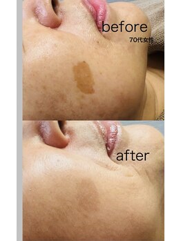 シューティングハーツ(SHOOTING HEARTS)/フェイシャルケア（70代女性）