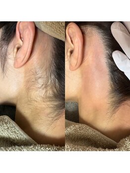 ルピナス(Lupinus)/うなじwax脱毛