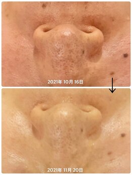 エステティックジュビラン アンビエンテ 福井南店の写真/毛穴の開き、黒ずみ、ザラつきまで一層！キュッと引き締まりつるんと光るクリア肌へ☆彡