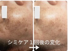 庭夢エステの雰囲気（W照射で最速シミ排出★光フェイシャル１回(1ヶ月後)のシミの変化）