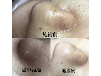 ビューティーネイル(Beauty Nail)/毛穴エクストラクション