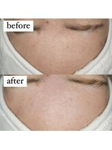 テンパ ビューティー(+10%beauty)/一撃タマゴ肌ワックス