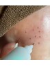 【初めての方】　低周波シミケア　お試し　5ショット　