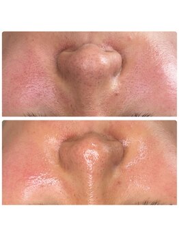 リノ(Lino)の写真/マスクを外す前に、毛穴とくすみを整えたい方へ◎艶肌Waxで明るくなめらかな素肌に！