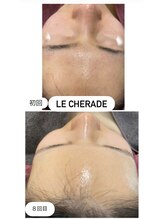 リシェラード/赤み、ニキビケア、毛穴ケアも♪