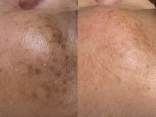 サラグランデ(Sara Grande)/シミケア7回施術