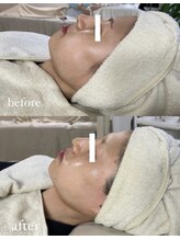 ミーミドットアイ(Mi-mi.i)/艶肌フェイシャルワックス脱毛