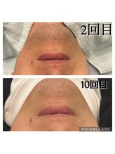 レイモード(Ray mode)/髭脱毛(爆抜け)