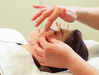 すみれ鍼灸整骨院/整体院の写真/【気になるたるみケアを美容鍼で】経験豊富なプロによる美容鍼でお顔周りのお悩み集中ケア!リフトUPも◎