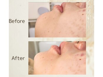 アンダブル(Andouble)/ビフォーアフター(幹細胞使用)