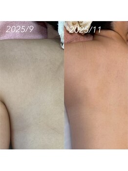 テテアテテ(tete a tete)/自分では見えない背中も綺麗に☆