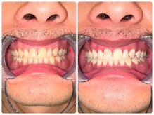 コナホワイトニング 神保町/メンズホワイトニング