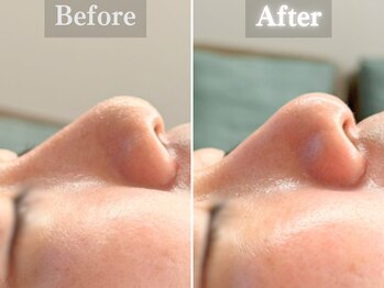 ボーンオム(Born Homme)/毛穴洗浄+美容液導入:20代女性