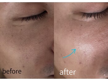 ルーム701(room701)/毛穴の黒ずみ洗浄 角栓