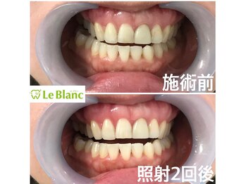 ルブラン 奈良店(Le Blanc)/白くするだけじゃない！！