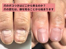 アリエ(allie)/ボコボコに生えてくる私の爪