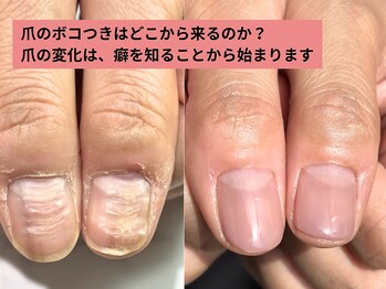 アリエ(allie)/ボコボコに生えてくる私の爪