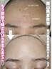 【毛穴悩み×ニキビケア】毛穴エクストラクション×国産ハーブピーリング