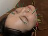 【むくみ/食いしばり/小顔/肌荒れ/即効性◎】美容鍼/顔全体60分☆8,000円