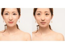 アユナタ(Ayu Natah)/フェイシャルビフォー、アフター