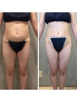 エクセレントビューティーサロン 艶(EN)/減量プログラム　６ｋｇ減量