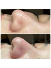 フェリーチェ(felice)/毛穴エクストラクション☆