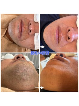 スパッツィオ(spazio)/【ヒゲ脱毛】14回 40代後半男性