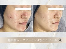 キレイ美肌 北心斎橋店/無添加ハーブピーリング