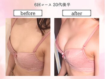 リール 恵比寿店(RIRE)/バストアップ症例【広尾恵比寿】