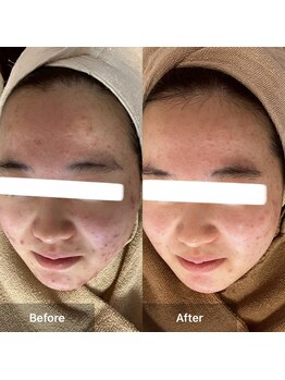 モカ 天王寺店(MOKA)/剥離ハーブピーリングニキビケア