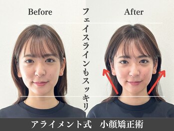 アライメントトウキョウ 表参道(Alignment TOKYO)/フェイスライン改善♪