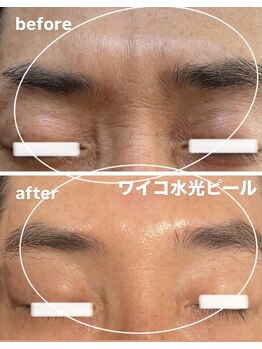 グレース(GRACE)/ワイコ水光ピール