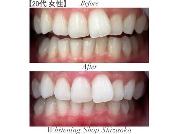 ホワイトニングショップ 静岡店/ホワイトニングBefore→After