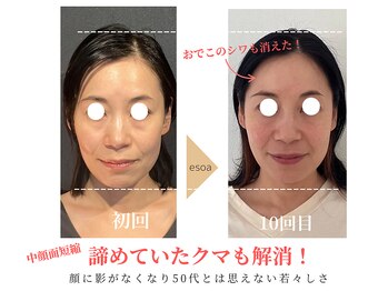 エソア(esoa)/50代 小顔矯正