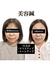 いまはやし鍼灸整体院 香椎和白店/美容鍼/たるみ/リフトアップ
