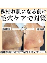 ピュール 鯖江店(PUR)/毛穴/毛穴ケア/毛穴洗浄