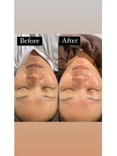 ギンザ リボーン(Ginza Reborn)/1回目の施術から出るツヤ肌