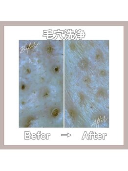 マヴィ 守口店(MavY.)/頑固な毛穴のお悩みに！