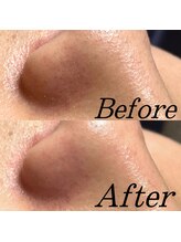 エクロム(eclomme)/毛穴ケア