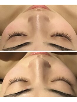 小顔フェイスラボ 四日市店(小顔FaceLabo.)/【オプション】隆鼻矯正