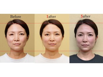 アプロ(APLO)/自律神経調整+小顔矯正