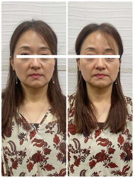 長寿鍼灸院 長寿整骨院/美容鍼50本の効果★小顔効果