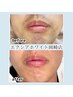 【新規限定】メンズひげ脱毛2回券★通常1回¥5,500→2回で￥5,500