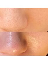 ミニョンプラス(Mignon+)/毛穴エクストラクションプロ